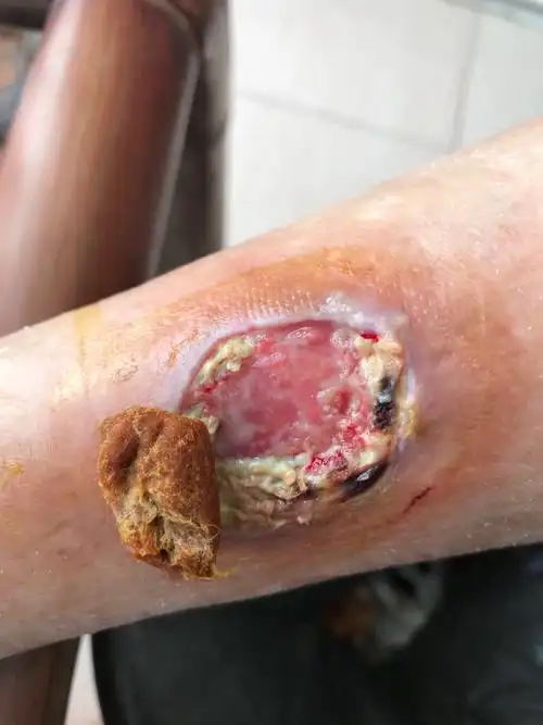 这是我把表面一层腐烂的坏死组织剪去后的创面!