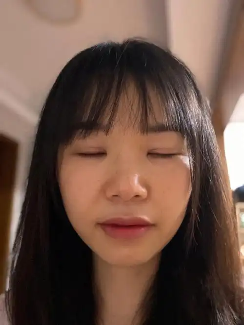 做完双眼皮十一周了