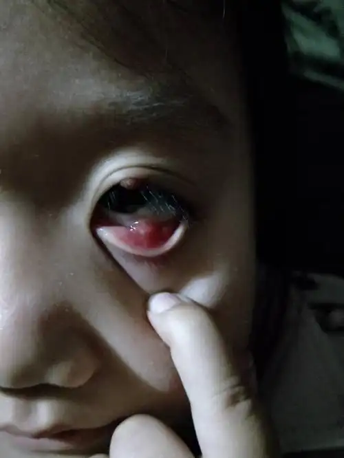 眼皮上长麦粒肿,需要手术吗