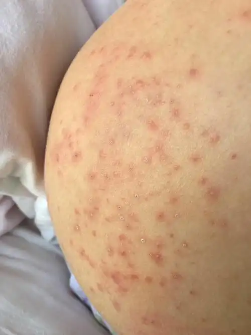 目前怀孕一个多月臀部湿疹晚上痒得睡不着抹了两周黑豆馏油