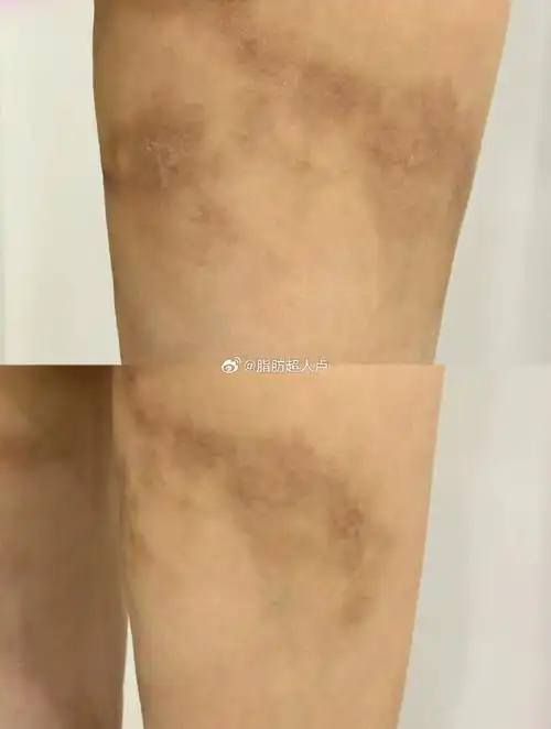 吸脂走过的弯路#大腿吸脂失败皮肤坏死,划重点7199"朋友"(可能是