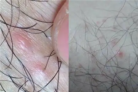 【图】毛囊炎治疗方法 这样可以有效去除它