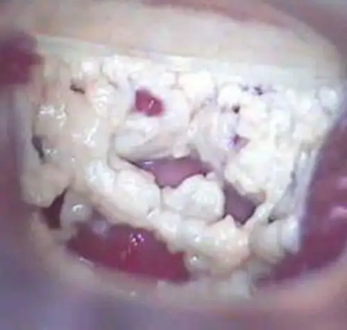 妇科疾病霉菌阴道炎图片_有来医生