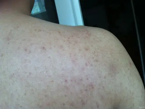 疑似毛囊炎用百多邦后