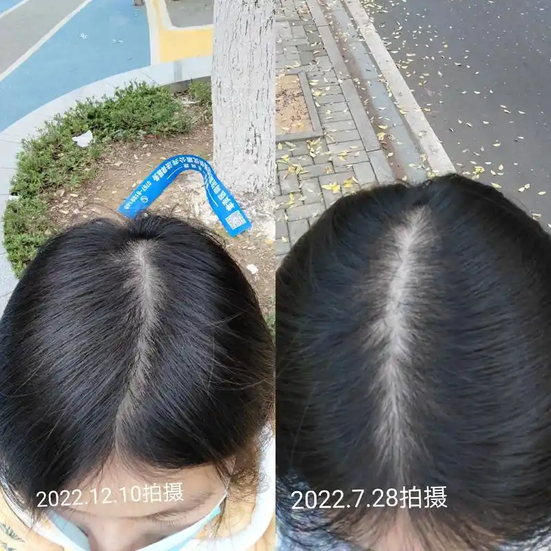 脱发治疗四个月前后对比照有没有效果看图片