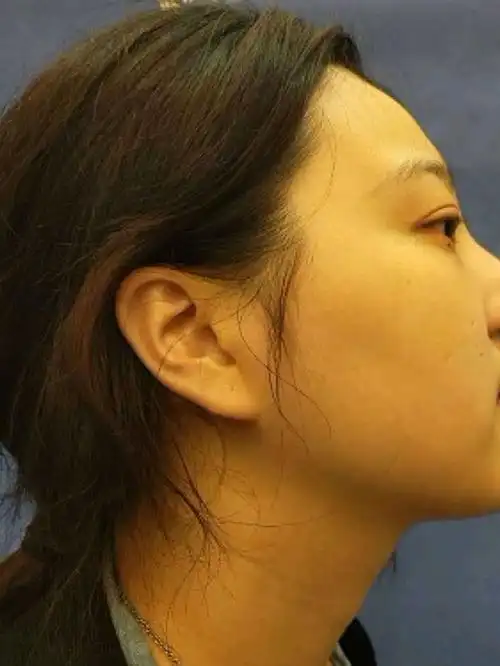 我的鼻梁很塌几乎没有山根,而且鼻头十分的肉,在我的_圈子-新氧美容