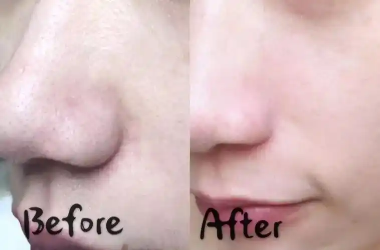 女星曝光素颜照黑头抢镜,真实的肌肤状态让人惊讶!