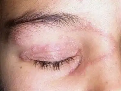 单纯疱疹病毒性睑皮炎的症状和图片 - 有来医生