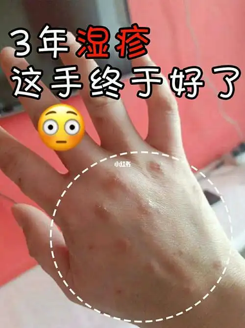 湿疹_皮肤问题_海鲜_熬夜_皮炎_白云山风景名胜区_运动_对抗湿疹大