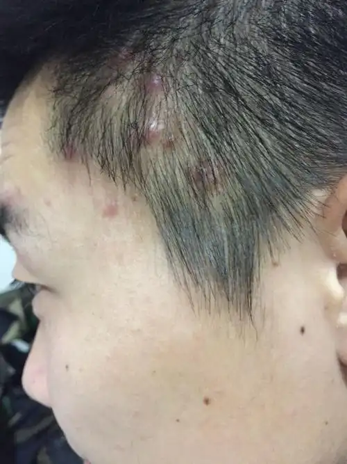 头皮上长痘痘头上的这几个痘痘长了快五年了,看过不少医院,也做过冷冻