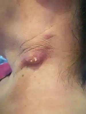 请问下大家有没有见过这种情况脖子上疙瘩3个月了昨天发现突出