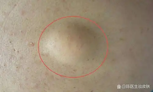 边界比较清晰,体积比较小,脂肪瘤(lipoma)是一种常见的软组织良性肿瘤