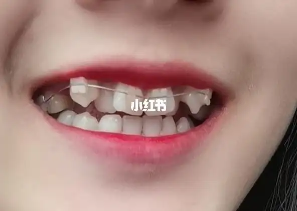记录虎牙正畸第一个月_牙齿矫正_美妆_医美整形