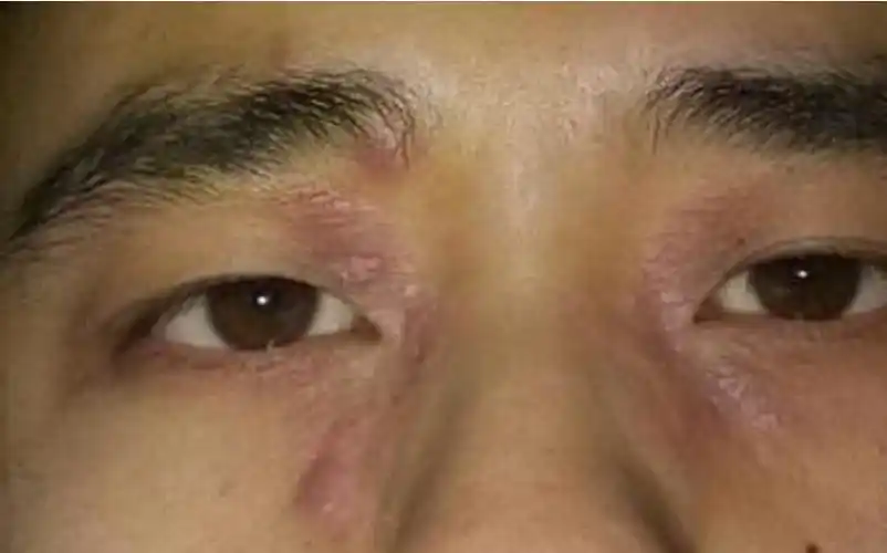 神经性皮炎图片_神经性皮炎症状表现图片大全_有来医生