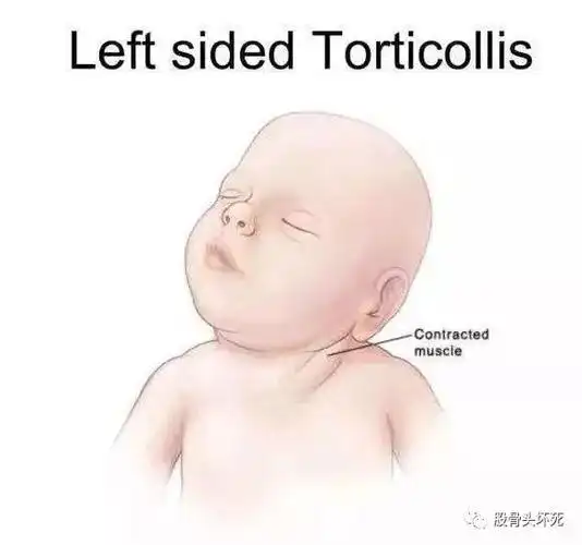 歪脖子病