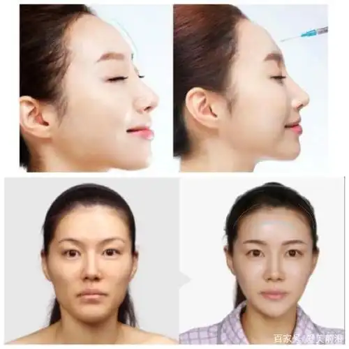 额头填充对比图