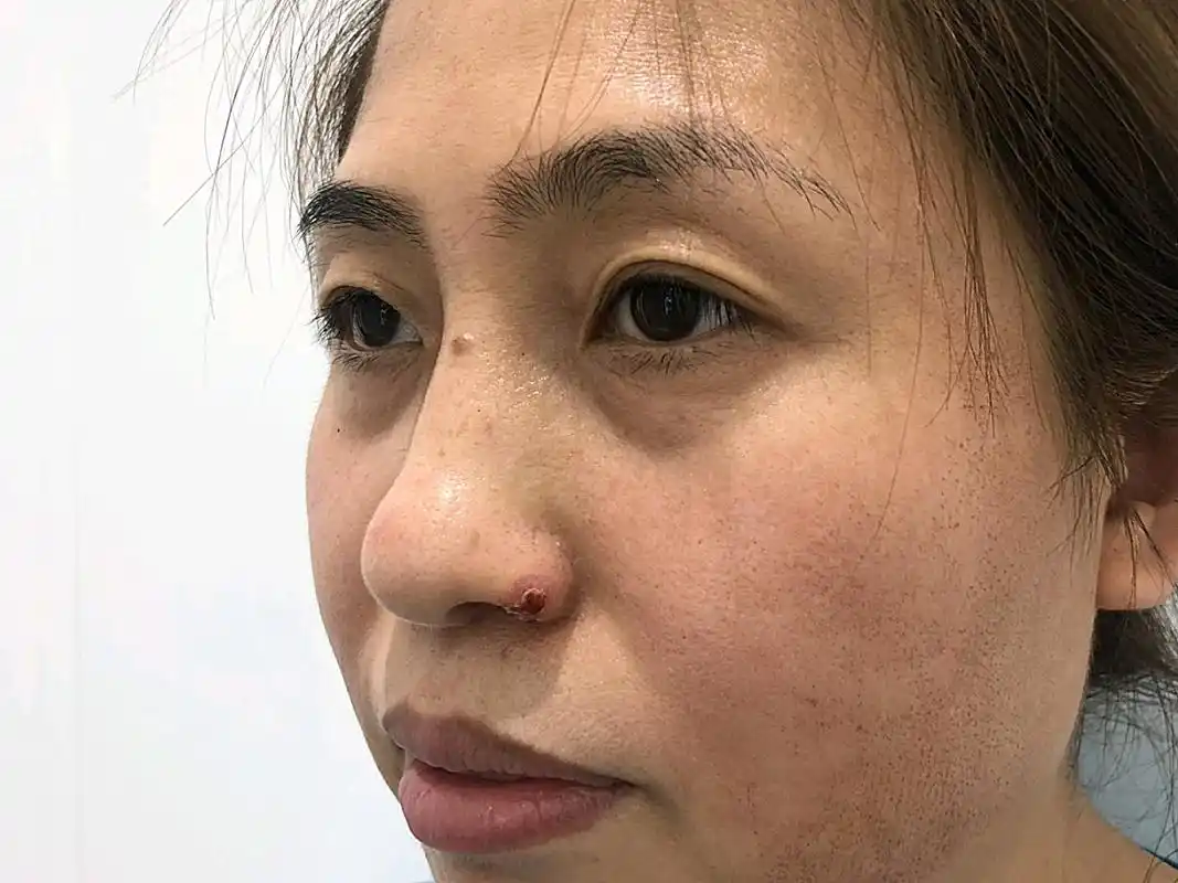 术前:我的皮肤状态一直不佳:毛孔粗大,暗沉发黄无光_圈子-新氧美容整