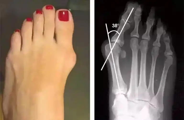 拇外翻?经常脚疼的人该注意了!