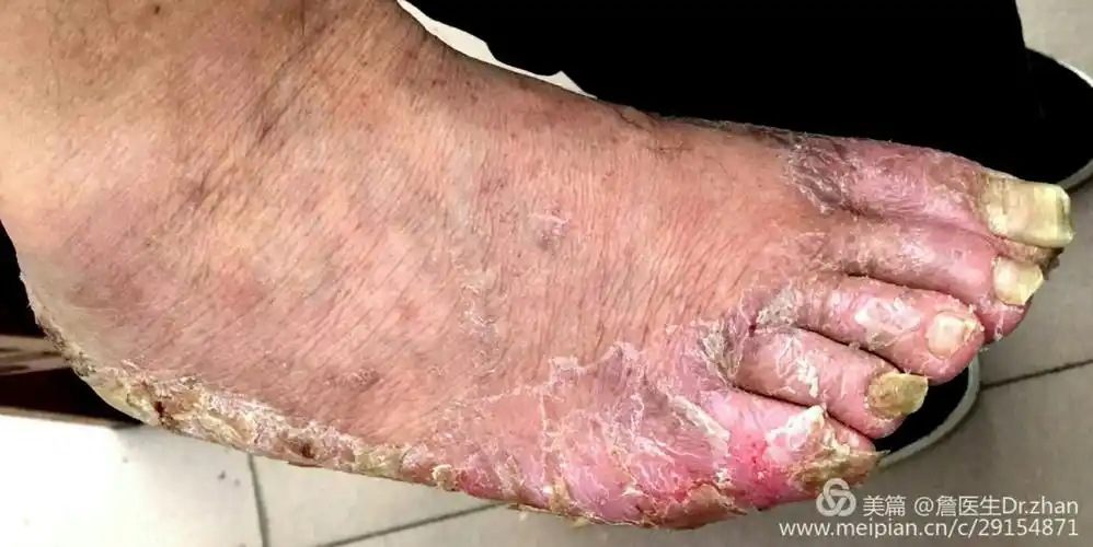 足癣- 美篇