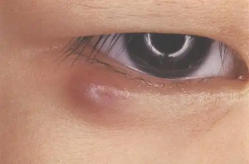(图) 下眼睑皮肤疖肿