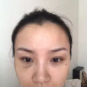 玻尿酸填充泪沟第三天好像越来越淤青都发黑了而且像打出了个眼袋怎么