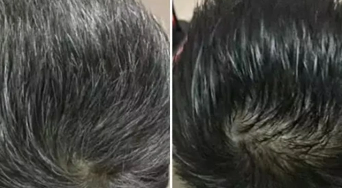 每天白发转黑案例精选 | 白发不要慌!及时调理,恢复乌黑浓密!