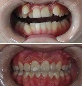 虎牙矫正案例对比