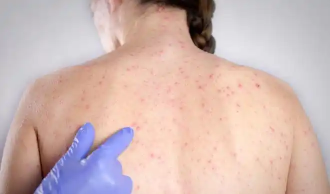 后背长痘痘,教你小妙招轻松赶走它|去角质|磨砂膏|毛囊炎|痤疮|爆痘