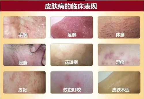 新品亮相 皮肤抑菌膏 抑菌止痒 各种廯症 神州神药业特供