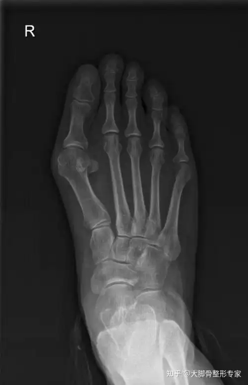 年轻人的轻度大脚骨,不做手术戴矫正带有效吗?