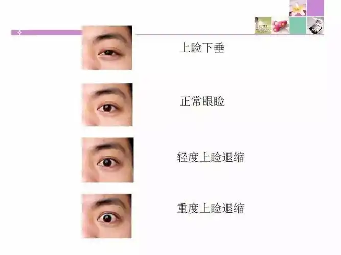 什么是眼睑后缩?眼睑后缩该怎么办?-张英主任医师-爱问医生