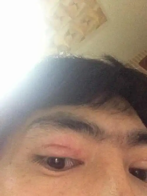 上眼睑红肿痒水泡,平均2到3天出现一次,反复的出现,大约出现一次2到3