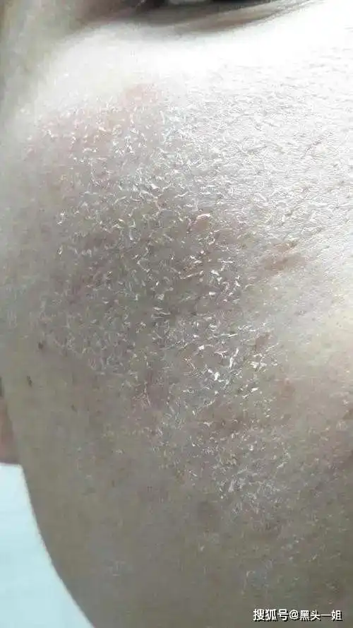 秋冬脸上用黑色衣服一擦就会有白白的东西,是太干了缺水导致的脱皮爆