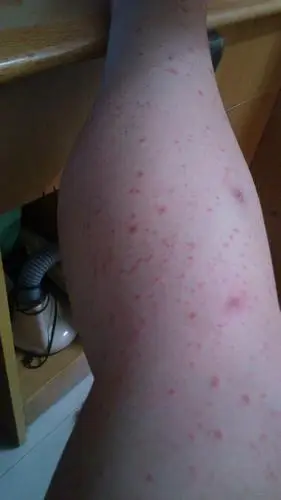 腿上会长这种红点,但是不痛也不痒,过一段时间自己会消失,但是过段