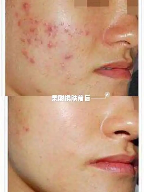 果酸换肤大揭秘想要美白祛斑祛痘看这里60