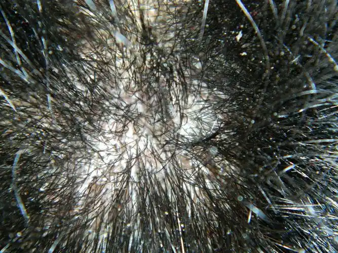 头顶有一块头屑特多,头皮发痒,老也治不好.