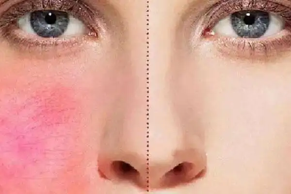 敏感肌和过敏肌的区别是什么