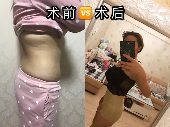 腰腹环吸手臂