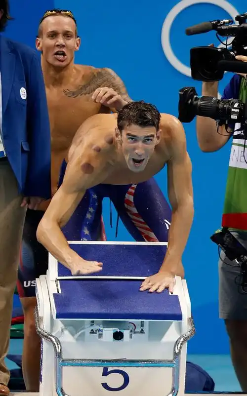 菲尔普斯两场比赛之间我都会拔火罐反正它对我挺有效