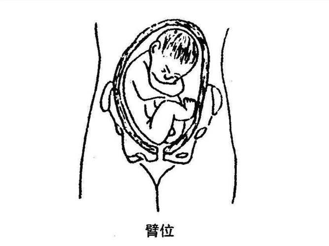 调整胎位正确姿势图臀位(为什么会形成胎儿臀位?如何纠正?