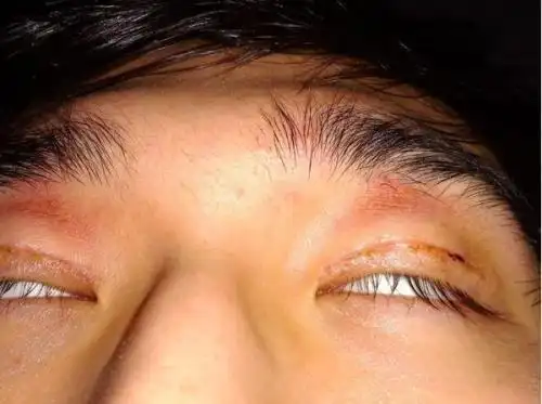 双眼皮术后为什么会出现闭眼不全?
