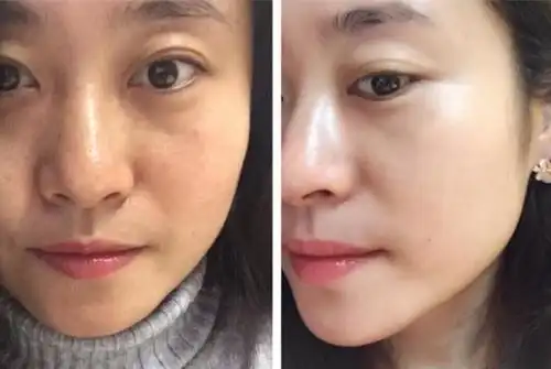 18岁女孩打美白针变"猪头",遭男朋友侮辱,美容院全程推卸责任