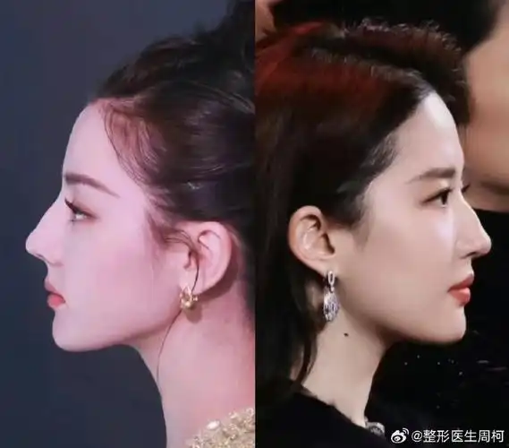 最近总有求美者要来做刘亦菲同款驼峰鼻,实话说我觉得并不好看,或者说