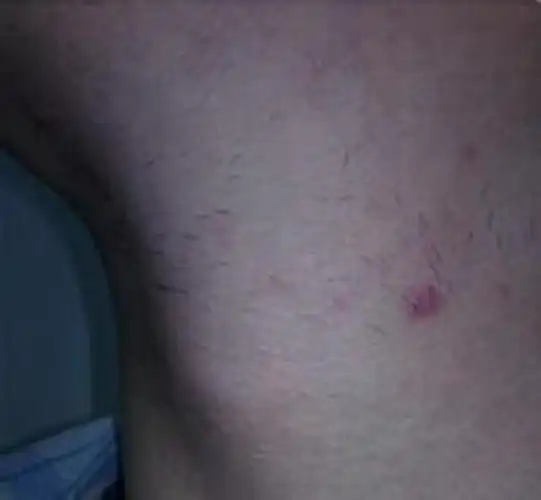 阴茎长毛囊炎的症状图片