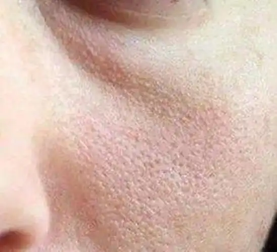 这些毛孔堵塞的症状,不处理皮肤会变差