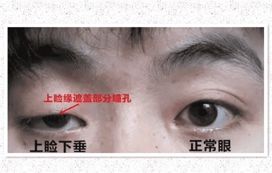眼睑下垂手术失败图片第三张不是真的吧