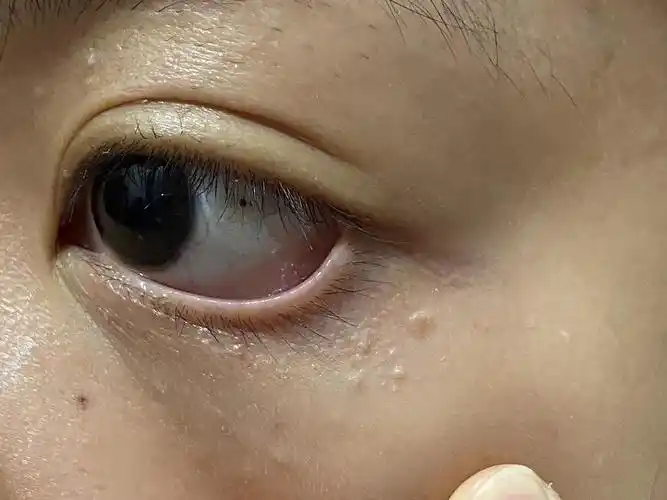 有jm知道这是脂肪粒嘛!