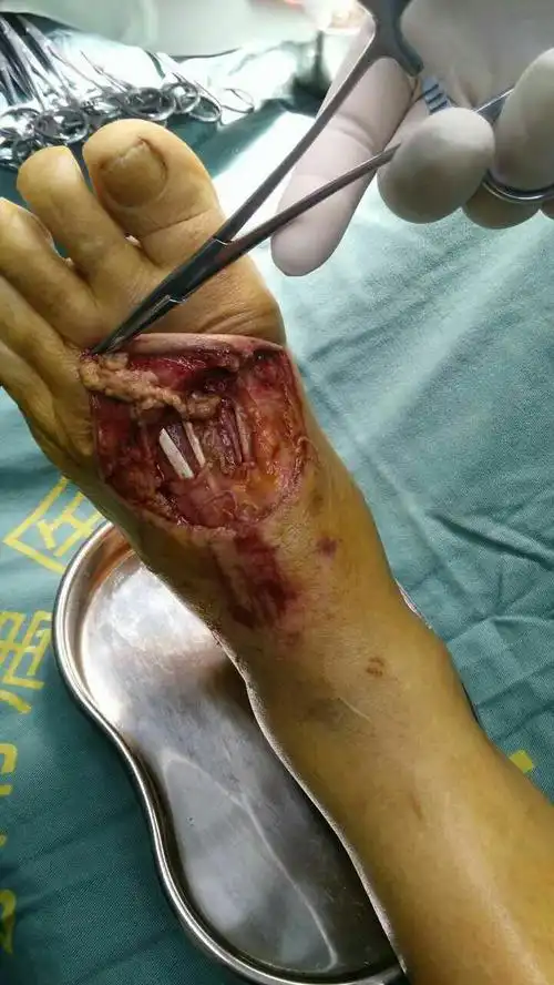 【2017年4月16日】女,64岁,左足被皮肤逆行撕脱清创探查神经损伤修复
