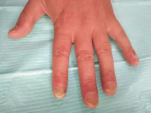 典型病例银屑病甲