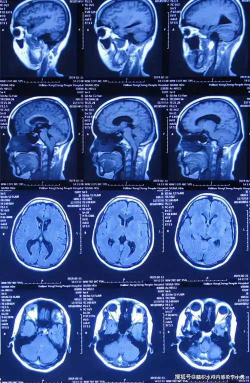 图-1:2019年2月10日头颅ct患者2019年2月初,因数次出现发作性黑蒙
